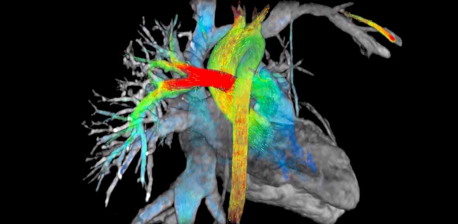 Data-driven medicine: blood flow in the heart, captured using a combination of magnetic resonance imaging and artificial intelligence software