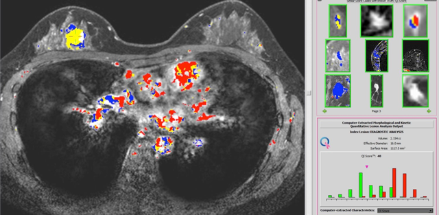 Screenshot of the QuantX workstation showing a breast MRI with kinetic color maps, similar cases, and the QI score for a benign lesion.  QuantX combines machine learning and advanced image analysis with a deep database of historical cases to assist radiologists in the assessment and characterization of breast abnormalities on MR images.