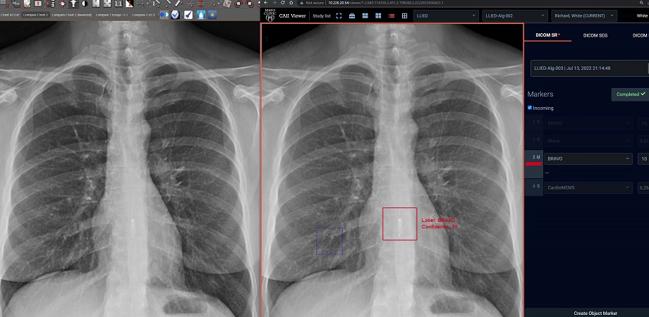 (Left) The standard clinical PACS (Picture archiving and communication system) frontal chest X-ray image, which does not detect/identify LLIED. (Right) ZF GUI/Viewer display of 12-class AI model inference result on the same monitor. 